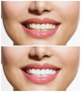 Woman Teeth Before and After Whitening. Oral Care