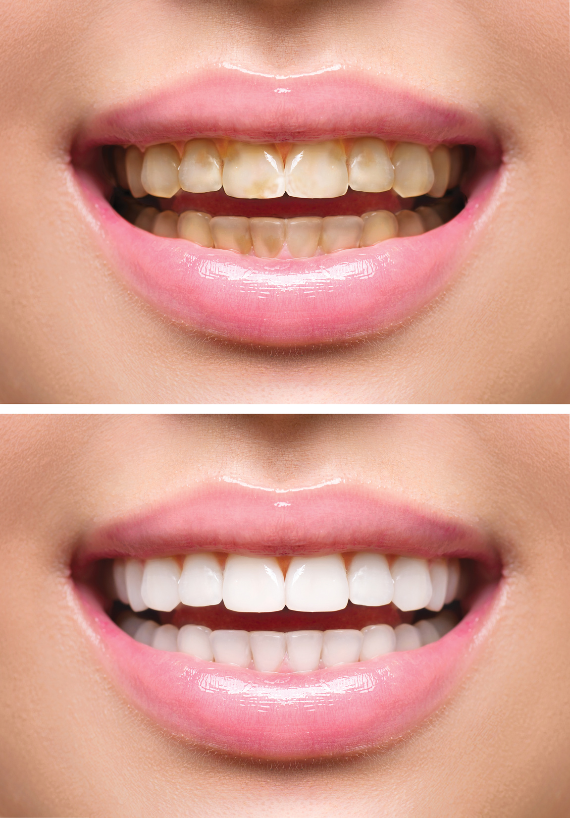 Blanchiment Des Dents : les différentes méthodes